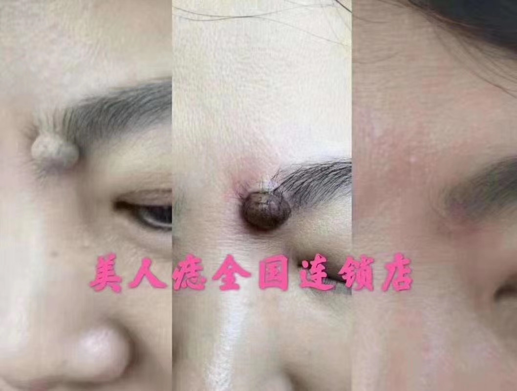 祛除眉头大肉痣案例对比图分享