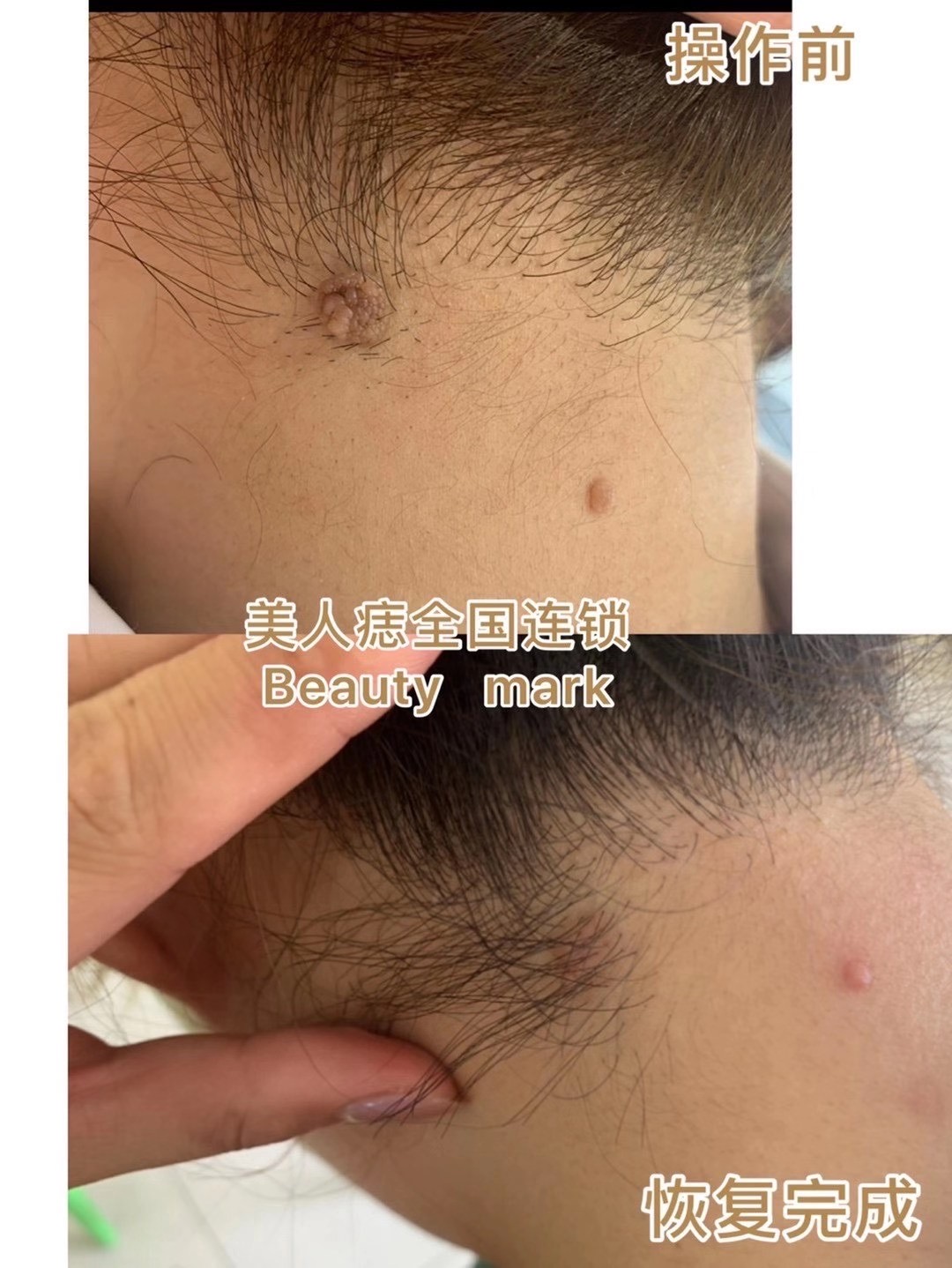 脖子后方肉痣去除案例分享