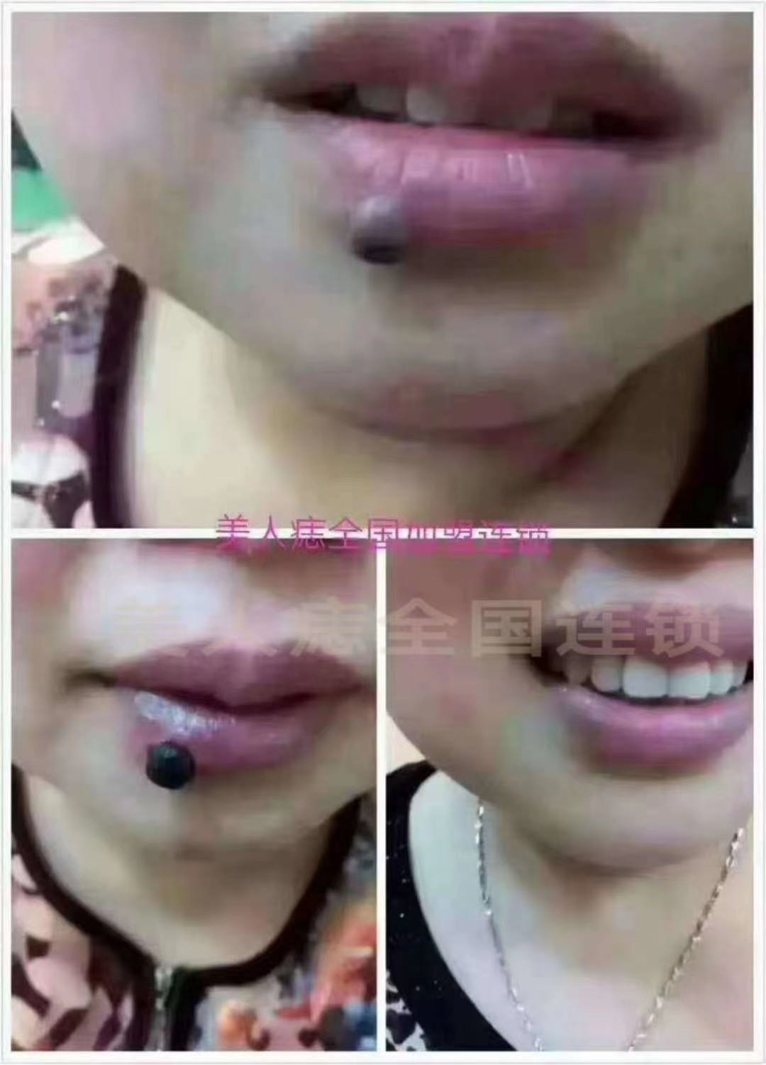 唇上痣去除案例分享