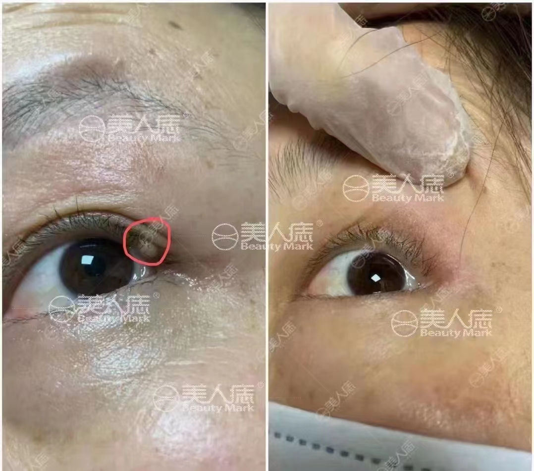 眼线痣去除案例分享