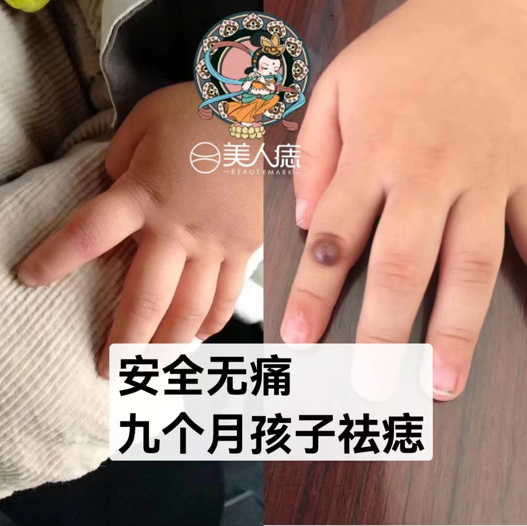 9个月宝宝手部胎记去除案例分享